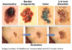 melanoma